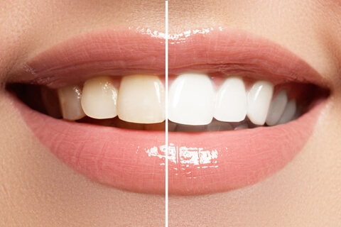 歯を白くするホワイトニング歯磨き粉